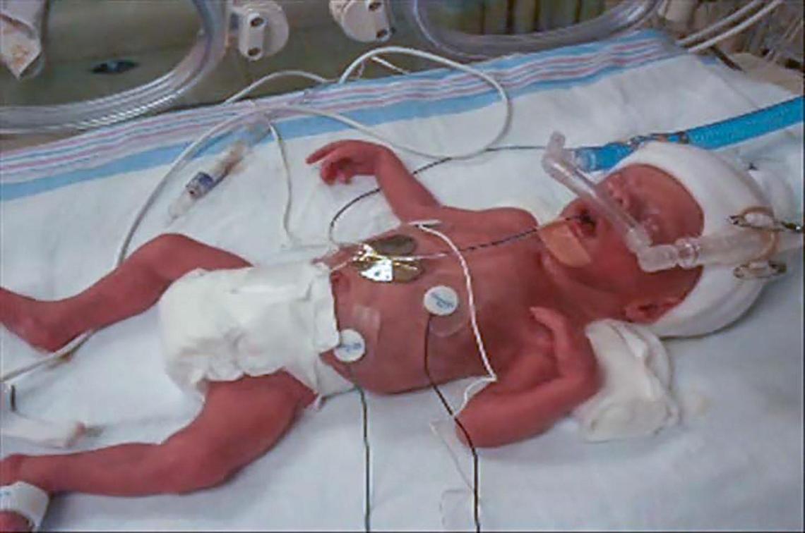 Brooks Martin was born prematurely, weighing only 2 pounds, 8 ounces. He was Tim and Amy Martin’s first child.