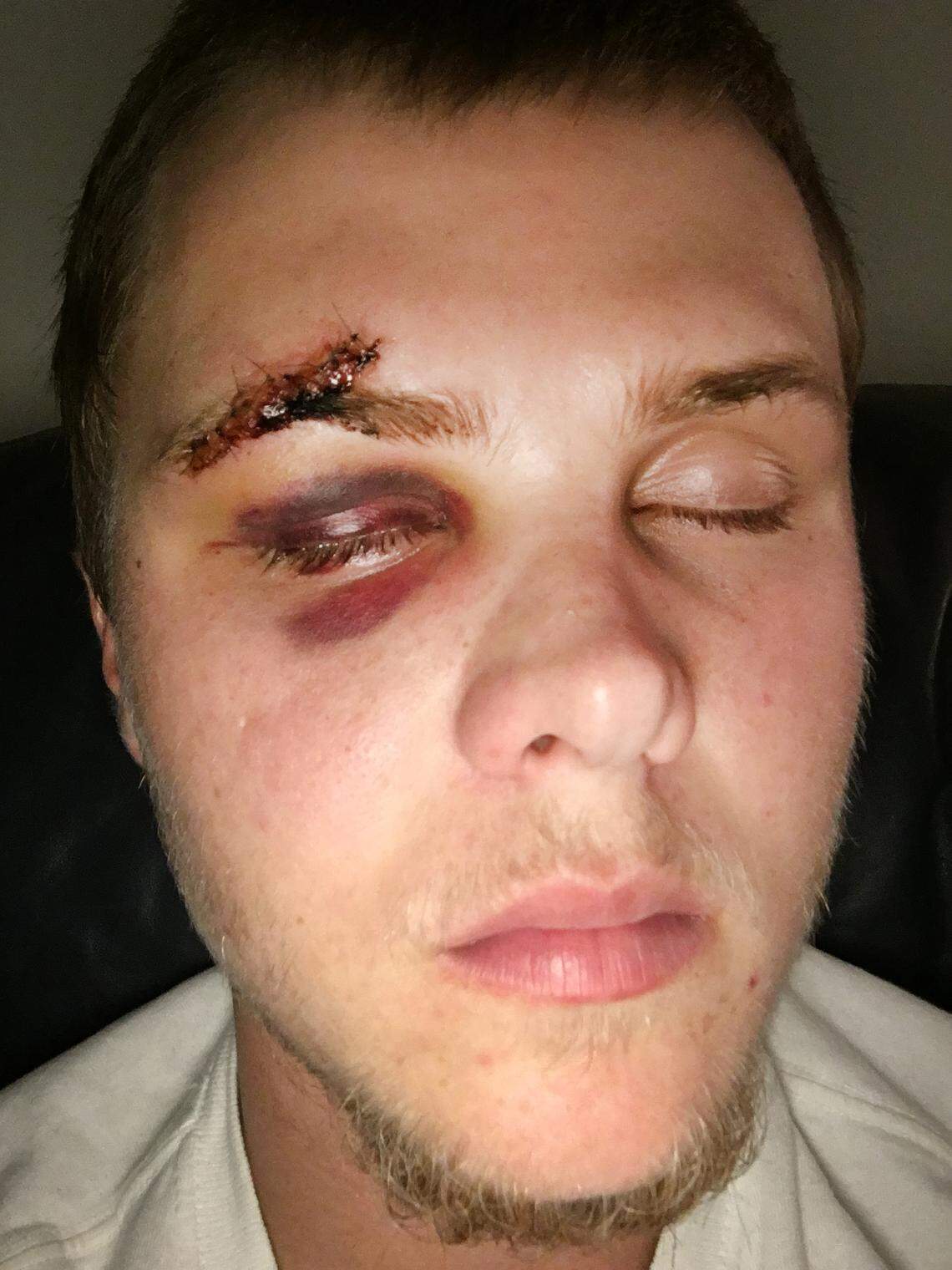 A look at Justin Hawkins’ eye after a freak baseball injury.