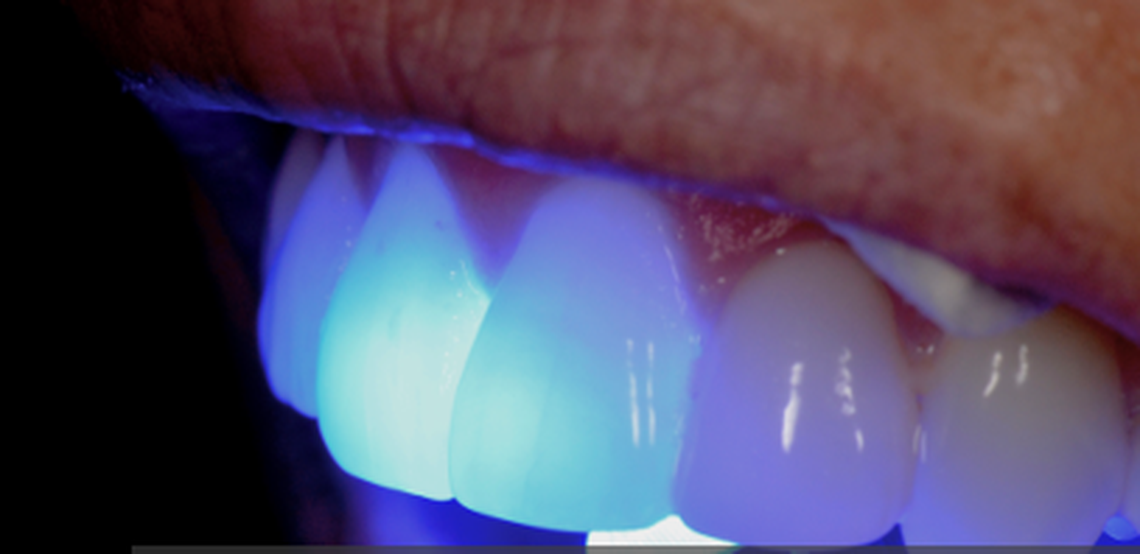 Hundreds of small water systems are abandoning fluoride as a way to protect children’s teeth because they say they can’t afford it