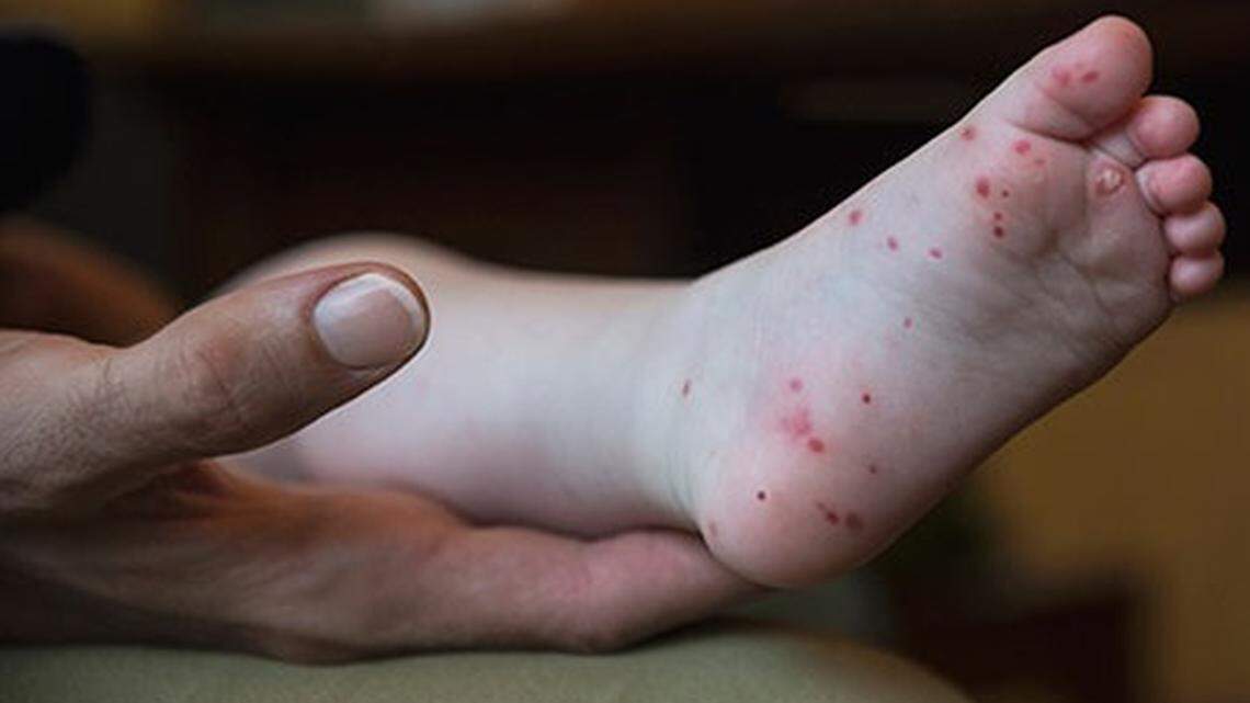 A rash of red spots or bumps is a sign of hand, foot and mouth disease.