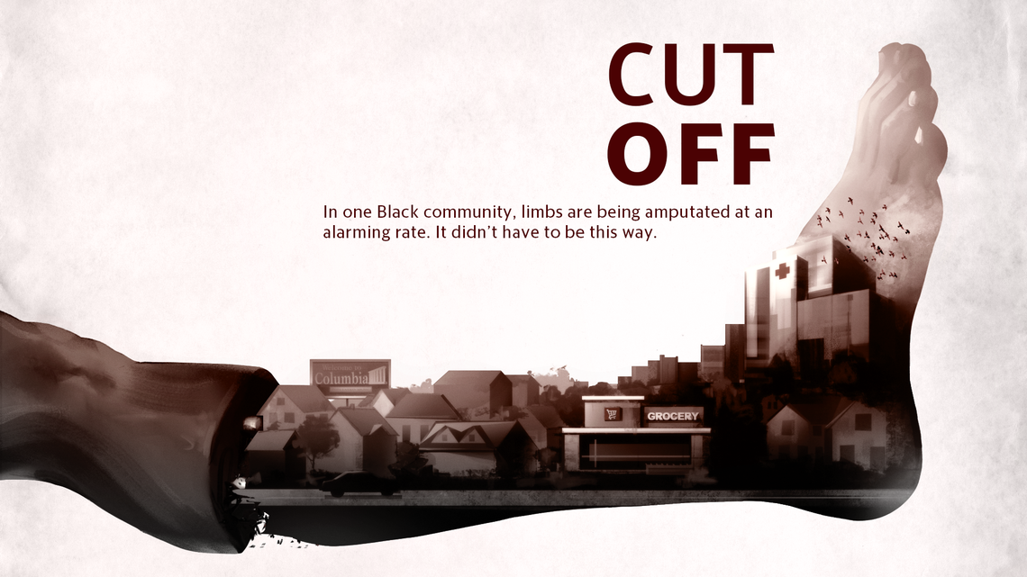 Diabetics are losing their limbs at an alarming rate in this SC ZIP code. Here’s why