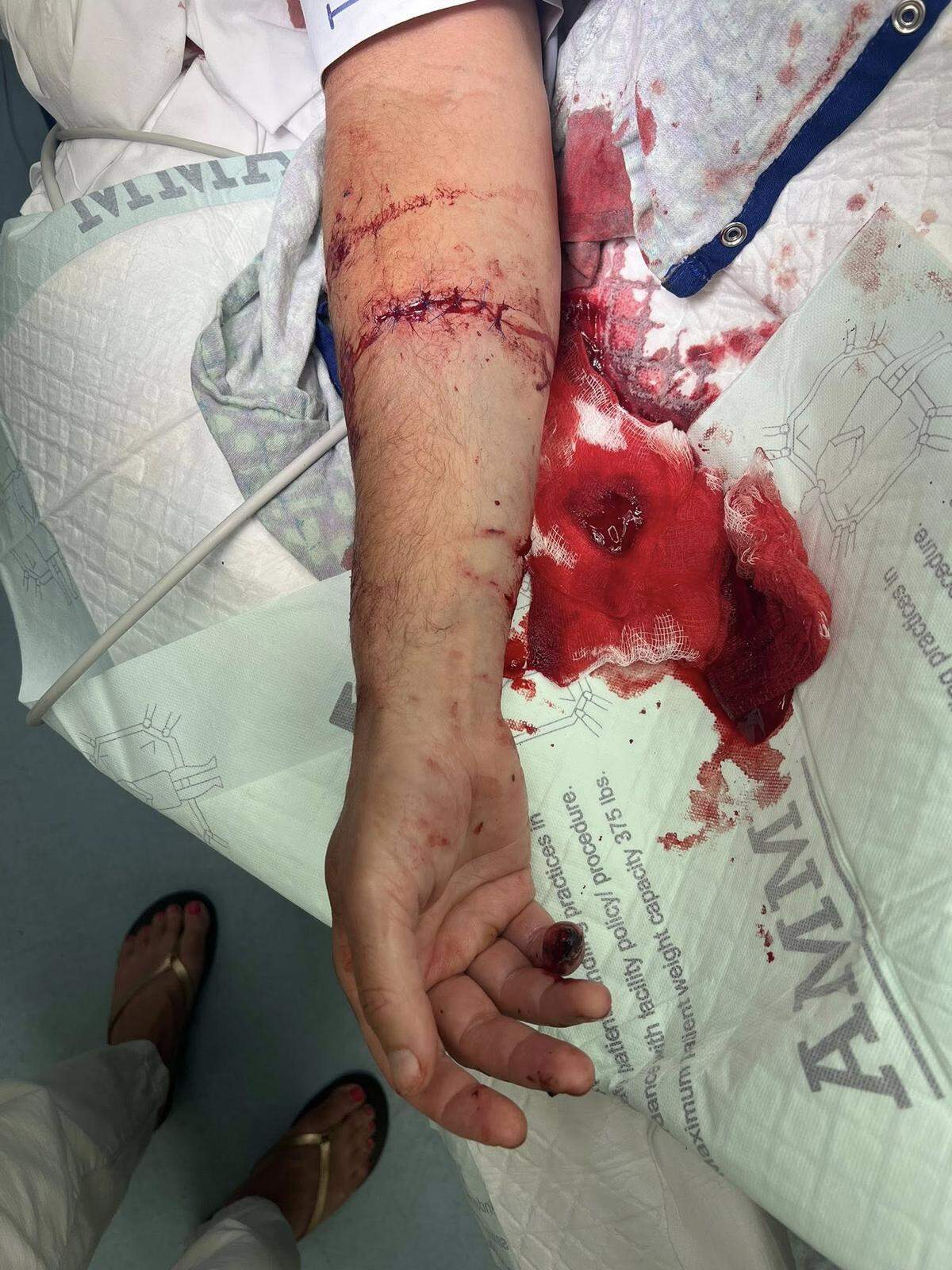 Federal prosecutor Winston Holliday was attacked by two pit bulls while on a run through Harbison State Forest on Saturday July 12, 2025. This photo shows one of the wounds he suffered.