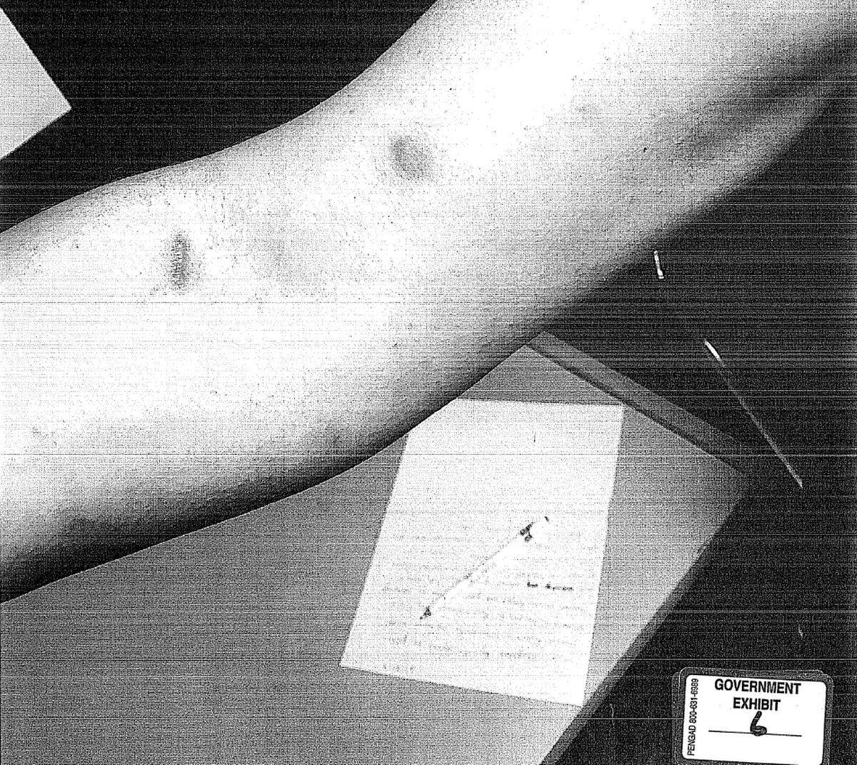 Bruising on E.B.’s arm presented as evidence with a statement she wrote to police in the background.