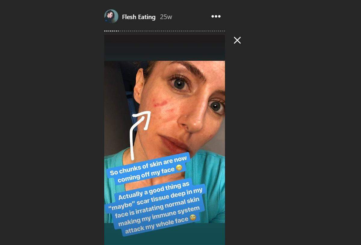 “So chunks of skin are coming off my face,” she said in one post in Instagram.