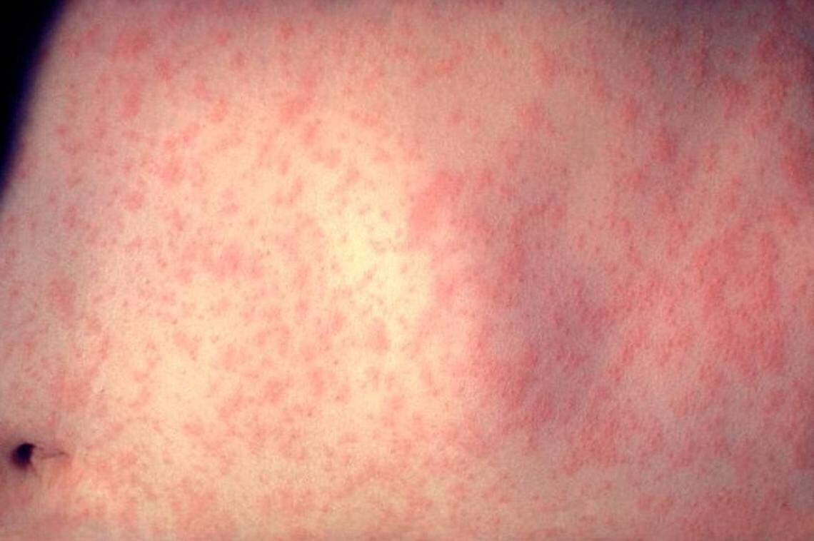 People with measles can develop skin rashes like the one shown here.