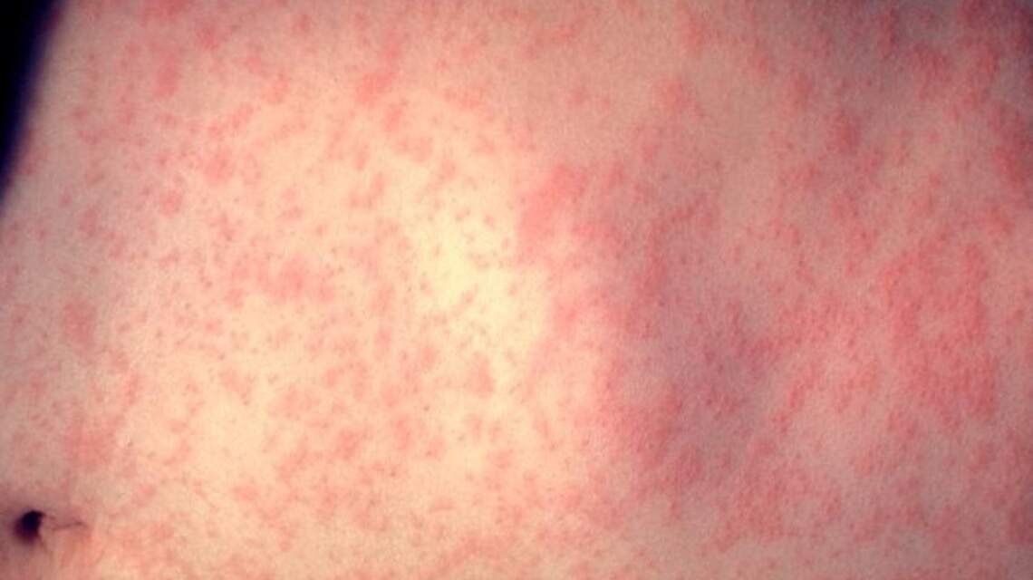 DHEC confirms 2 new cases of measles in SC
