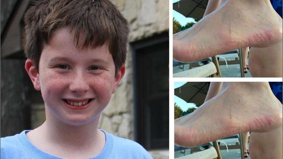 10-year-old Johnny Simatacolos was bitten by a small shark on Hilton Head July, 29, 2017.