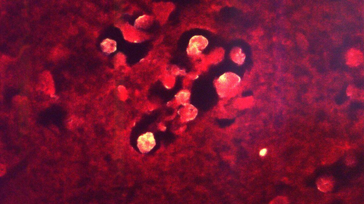 Under a magnification of 504X, and implementing the direct fluorescent antibody (DFA) staining technique, this photomicrograph depicts the histopathologic characteristics associated with a case of primary amebic meningoencephalitis due to Naegleria fowleri parasites.