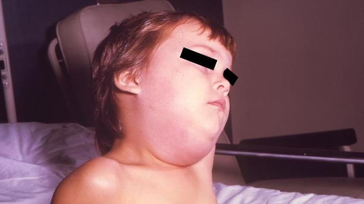 This image depicts a child with a mumps infection. Note the characteristic swollen neck region due to an enlargement of the boy’s salivary glands.