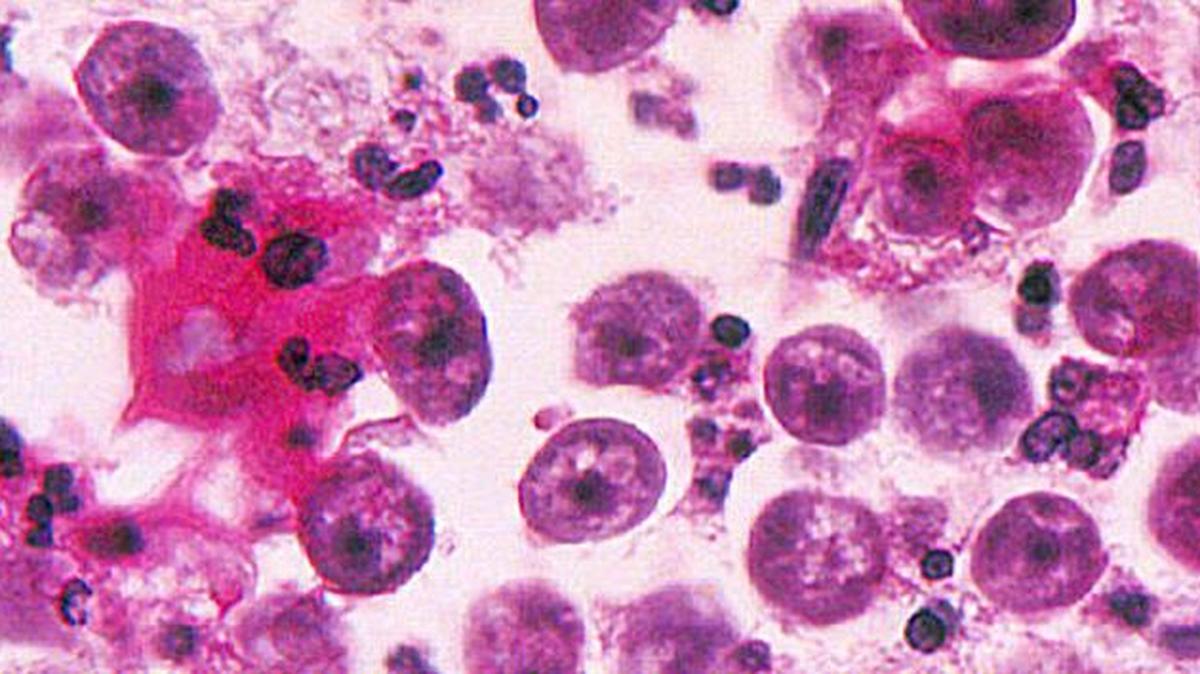 Naegleria fowleri